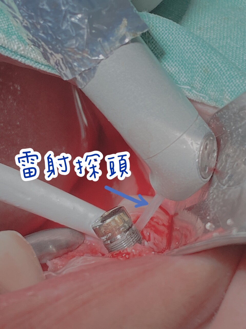 -診療項目-植牙3